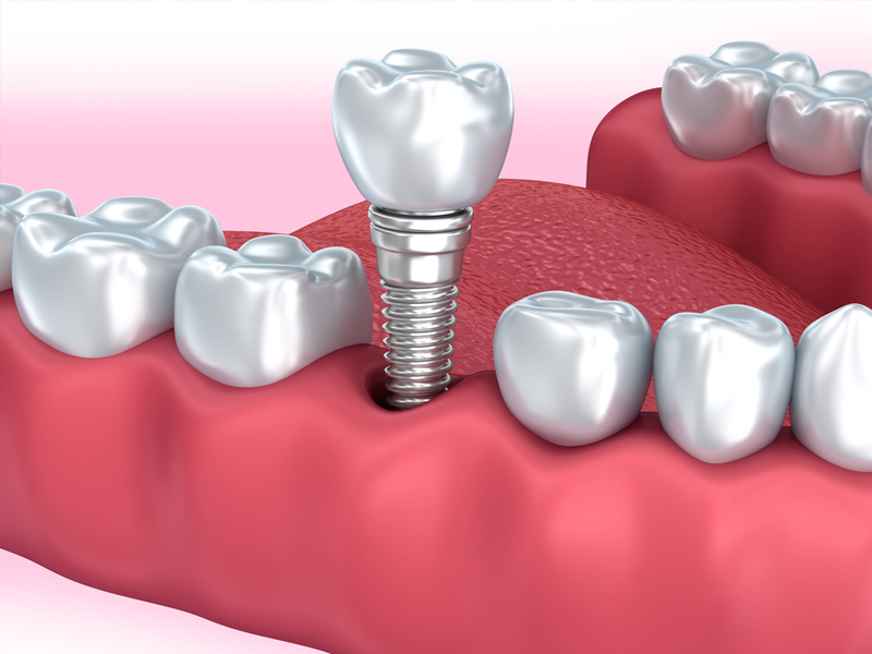 Dental Implants