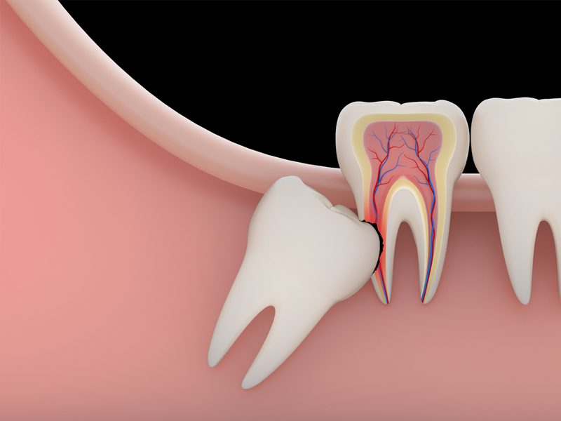 Tooth Extraction